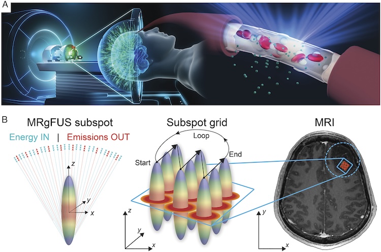 Localized blood-brain barrier opening in infiltrating gliomas with MRI-guided acoustic emissions-controlled focused ultrasound