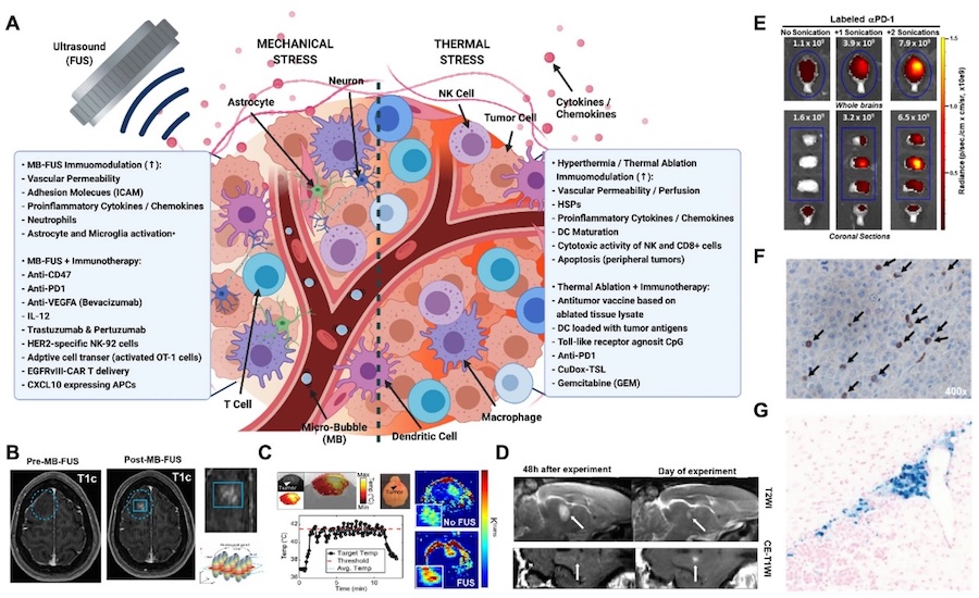 The roles of thermal and mechanical stress in focused ultrasound-mediated immunomodulation and immunotherapy for central nervous system tumors
